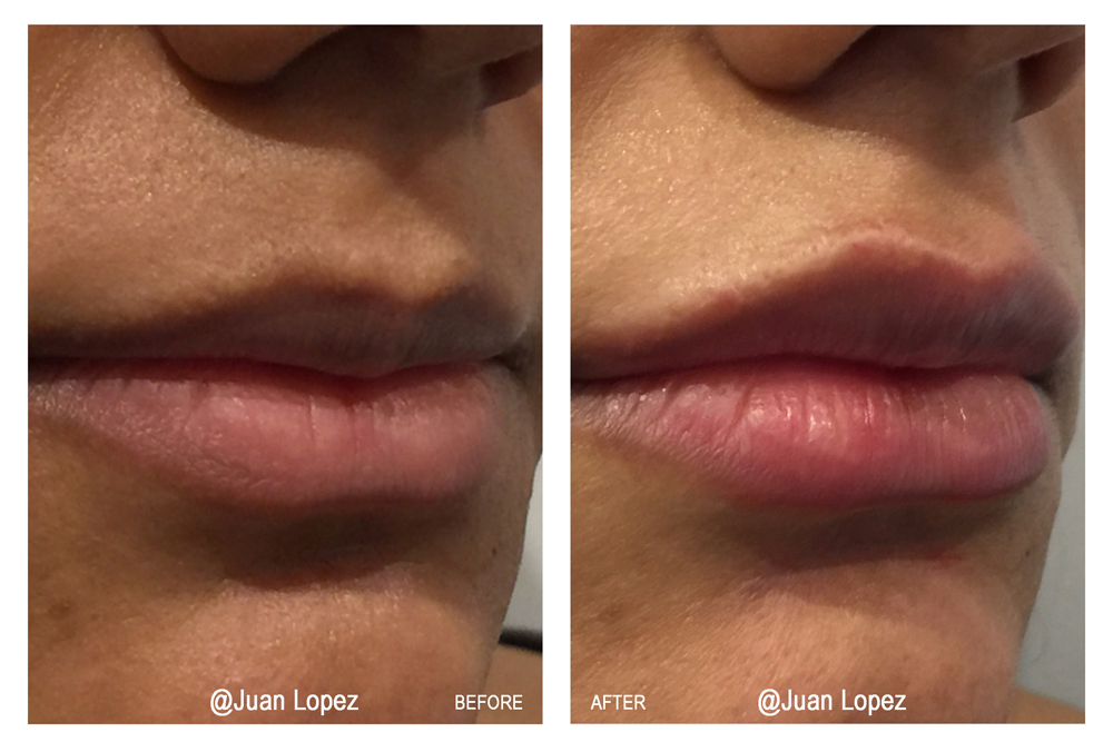 SkinMedico - Lips Treatment - Juan Lopez - small