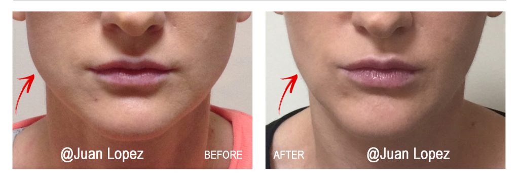 Masseter Reduction with Botox - Bruxism Treatment - TMJ Treatment