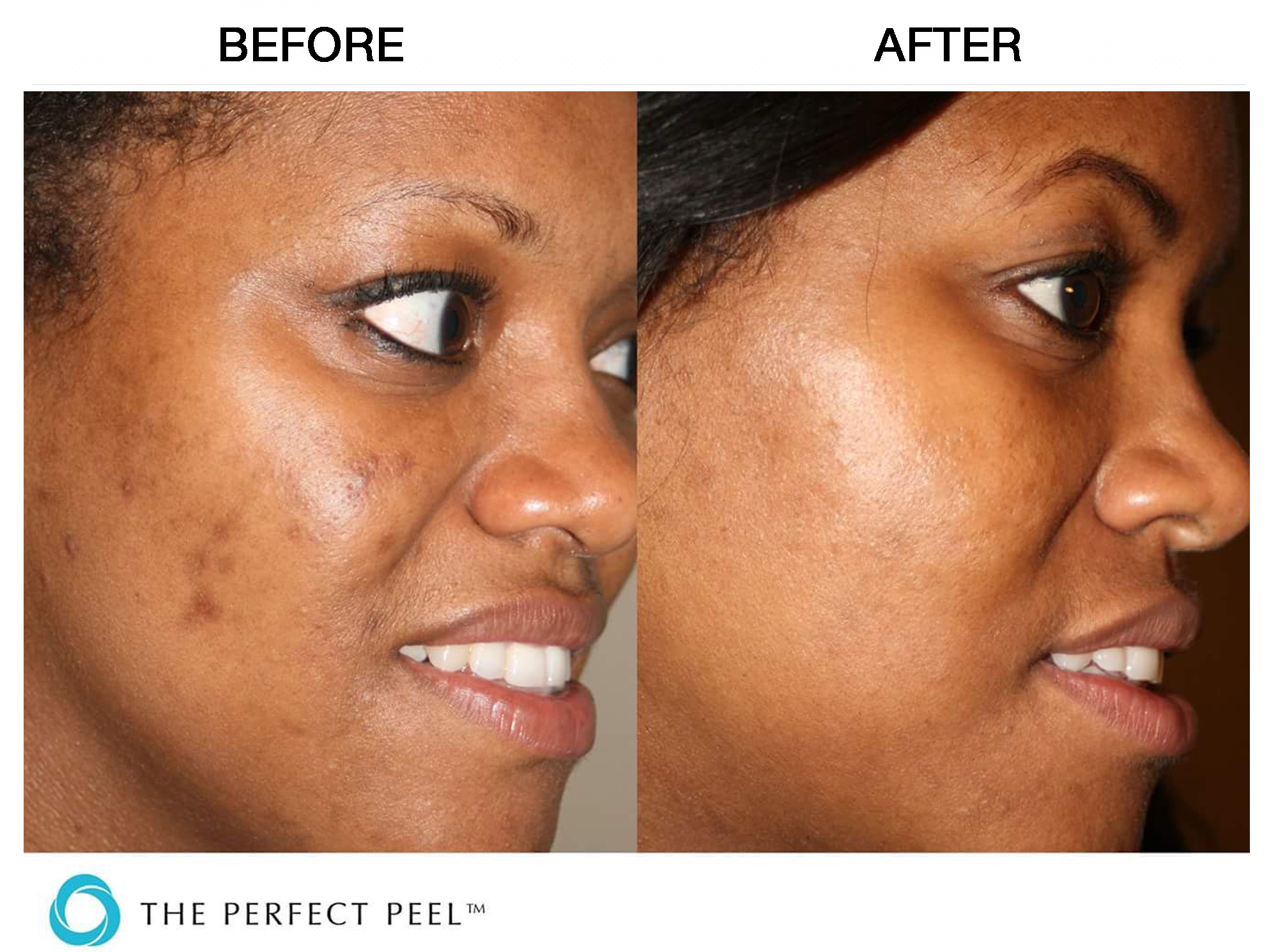 The Perfect Peel SkinMedico Clinic London